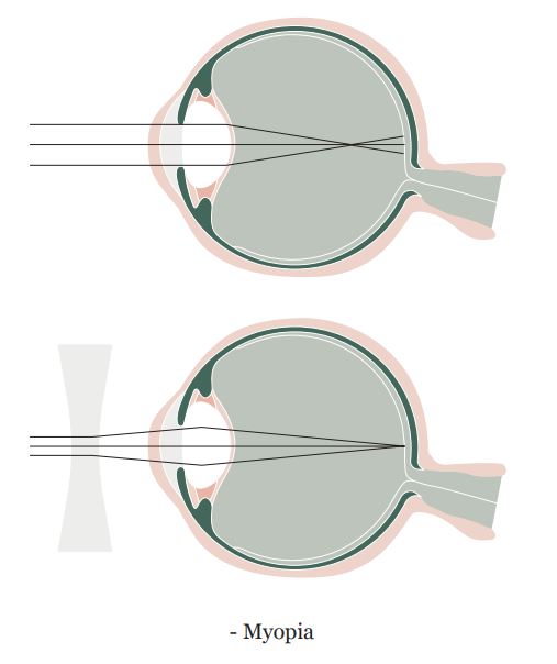 Myopia 